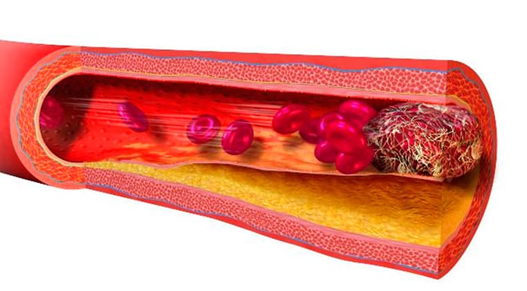 embolia-arterial