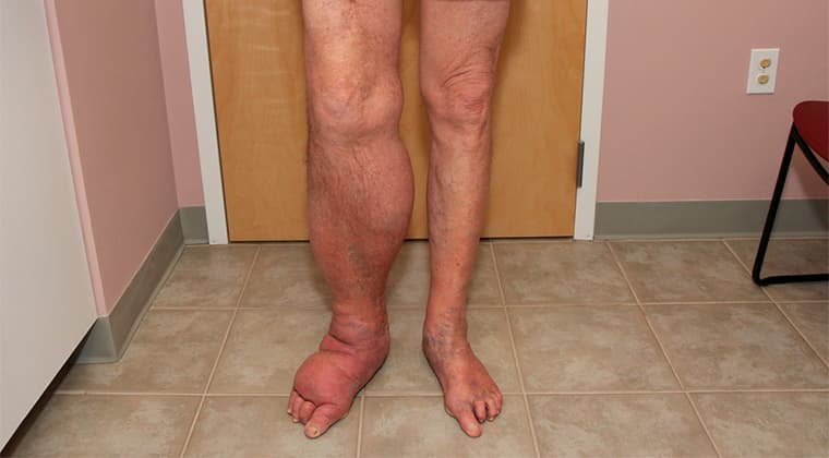 Linfedema