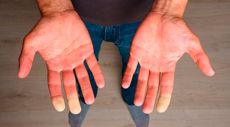 sindrome-raynaud