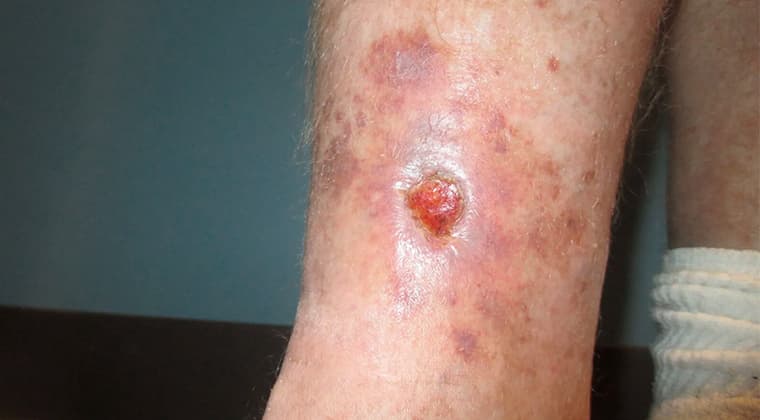 Úlceras venosas