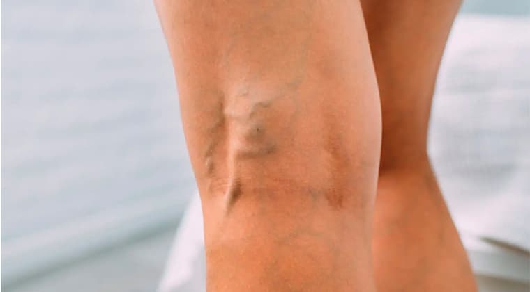 varices