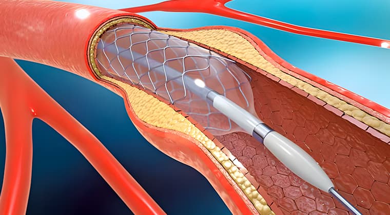 Angioplastia y stent