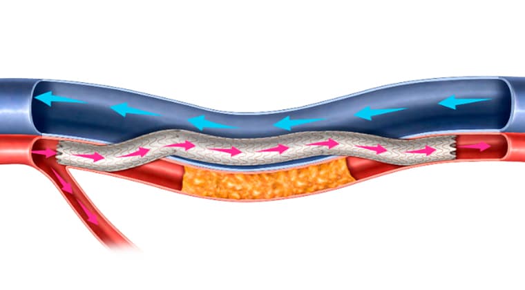 Bypass arterial