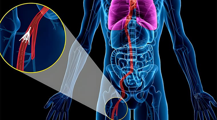 Filtros de vena cava