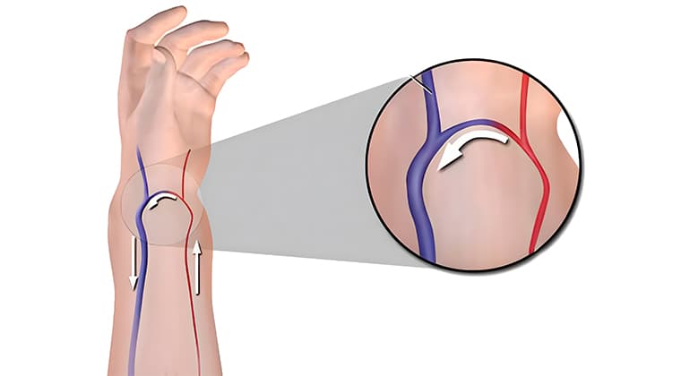 Fístulas arteriovenosas
