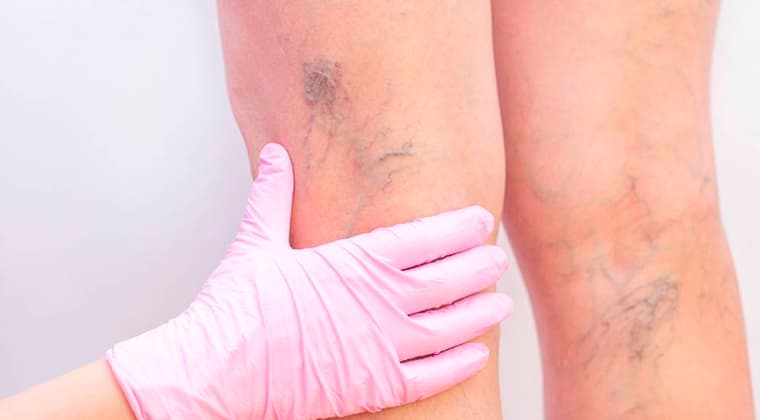 Manejo médico de la enfermedad arterial periférica