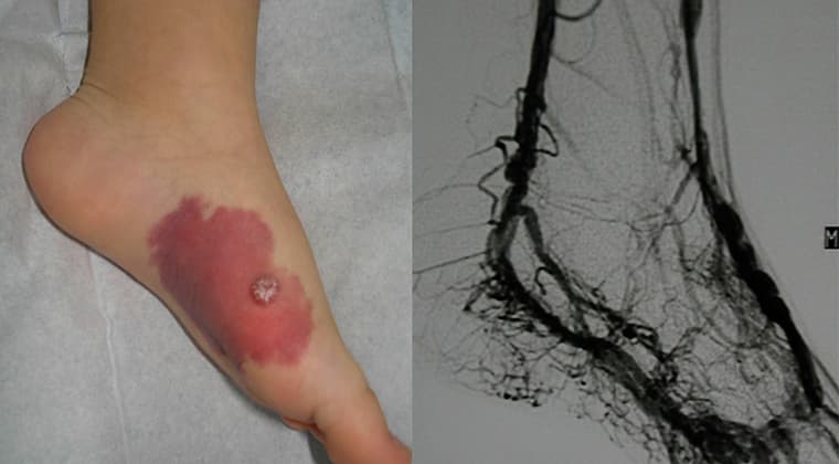 Tratamiento de tumores vasculares y malformaciones arteriovenosas