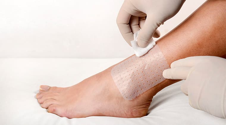 Tratamiento de úlceras venosas y arteriales